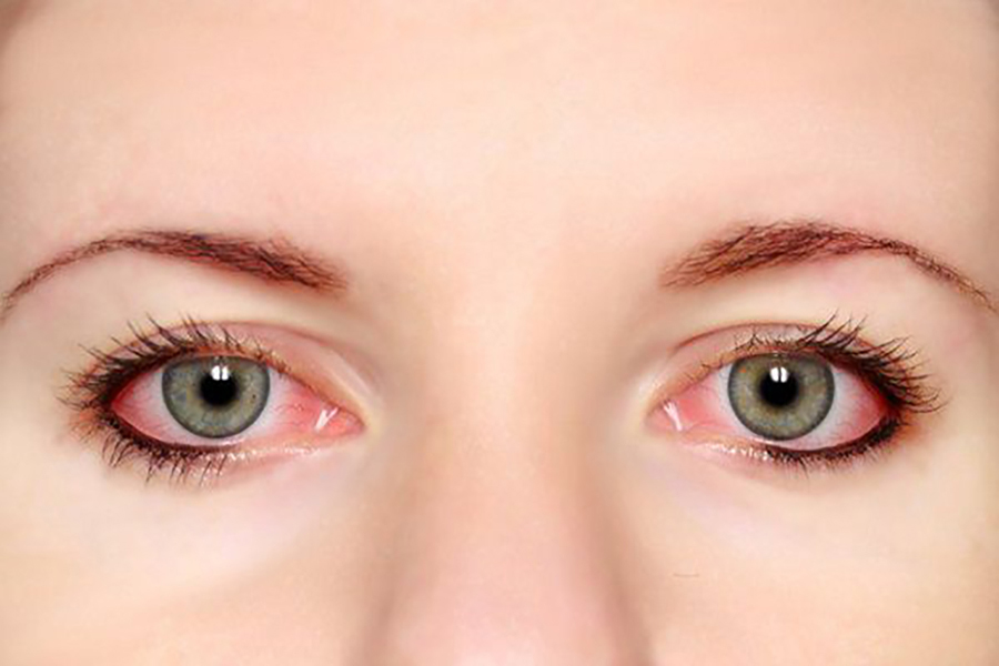 Người bị đau mắt đỏ cần kiêng một số loại thực phẩm để phục hồi nhanh chóng
