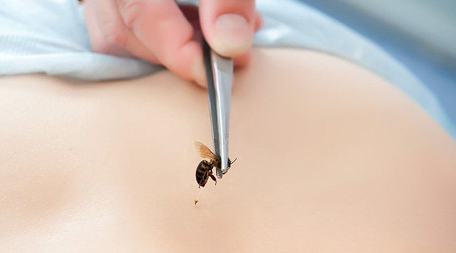 Bạn có thể dùng móng tay, gạc hoặc thẻ nhựa để gạt ngòi ong ra